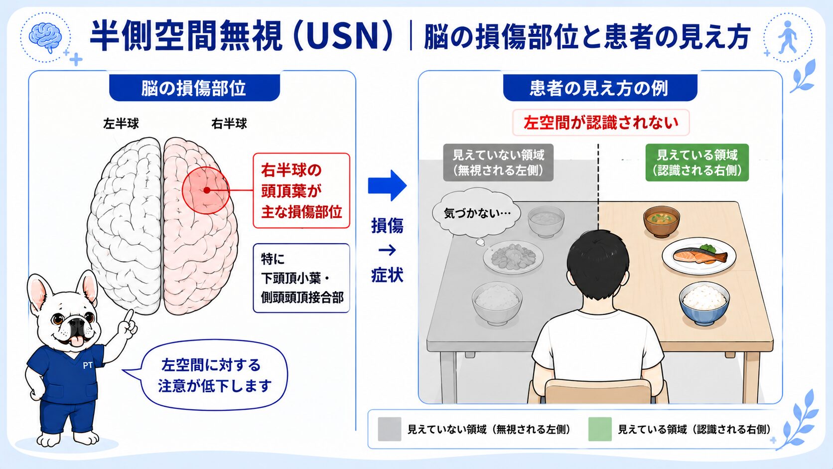 半側空間無視(USN)の脳の損傷部位と患者の見え方(右半球頭頂葉の損傷で左空間が認識されない)